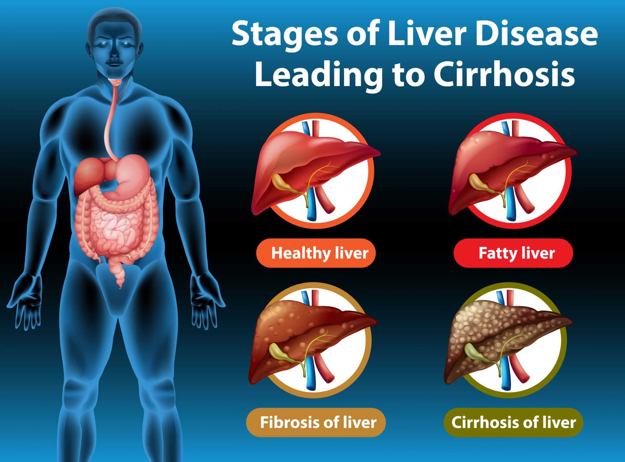 Keto Diet For Fatty Liver Disease: All You Need To Know About NAFLD